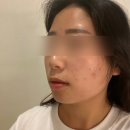 만성 여드름 피부, 대구 수성구 피부관리 린앤스킨 내돈내산 압출 여드름케어 솔직후기