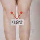 무릎관절 족관절염 치료혈자리 이미지