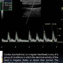 Arrhythmia on vascular ultrasound 이미지