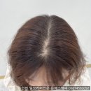 정수리 이미지