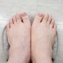 푸스케어 구로항동점 | 천왕역내성발톱 푸스케어 구로 항동점 후기 | 내성발톱 교정 제대로 받았습니다