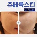 수완하얀피부과의원 | 쥬베룩스킨 리얼후기 을지로피부과 리나인의원