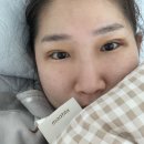 잘빠짐 - 용인시 처인구 | [오늘의일상]쌍수4-5일차 후기: 붓기 아주 잘빠짐 이제 사람같다