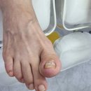 연향번영길 | 광양내성발톱 광양발관리 광양무좀 레푸스 순천연향점 솔직후기