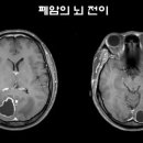 뇌암 치료 길 여는 `장벽` 자물쇠 풀렸다…임상시험 진행 / SBS 이미지