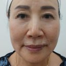 [광명실리프팅]광명실리프팅이란? 피부 탄력 개선부터 안면 윤곽 변화까지