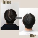 디비전 스칼프 | 수원 남자 가르마 정수리 머리숱 스트레스, 두피문신 커버업 후기