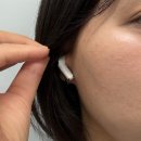 얼굴 편평사마귀 편사 제거 후기| 한 달 반 지난 후기 및 색소침착 관리