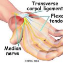 수근관 증후군[carpal tunnel syndrome] 이미지