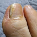 세븐일레븐 평내리치플러스점 | 평내호평 무좀발톱 스케일링 솔직후기 #슈블리왁싱&amp;푸스인솔