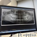 명문치과의원 | 홍천 서울명문치과 사랑니 발치 후기
