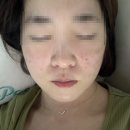 더편안한의원 | 영등포 당산피부과, 쥬브아셀V 도움의원에서 받은 내돈내산 후기(효과, 전후비교)
