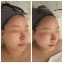 제이메디 | 송도윤곽관리 제이메디스킨 LPG 모빌리프트 후기