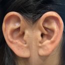 이혈(귀) 상담과 건강관리 이미지