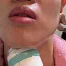짐엑스 신대방점 | 얼굴 턱 고주파 리프팅 서울 온다 리프팅 전후 비용 부작용 후기