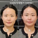 흥덕중앙로 5 | 용인 에스테틱 용인피부관리 로 80분만에 드라마틱한 비포 앤 애프터 리저브미 윤곽후기