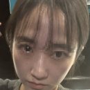 더예그린한의원 | 천안 리프팅 써마액티브 아큐써마 받은 후기 2주 뒤 경과