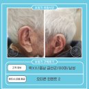 금산-49 | 금산보청기,박XX고객님 오티콘 인텐트 2 구매후기(80대,男)
