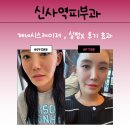 제네시스 | 신사역피부과 제네시스레이저 , 실펌X 후기 효과 !