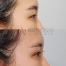 쌍수 절개 붓기 후기 3주-한달-3개월