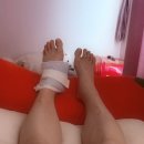 보궁요양병원(회장) | [번외] 발목 인대 부주상골 후경골건염 투병기 &amp; 회복과정