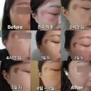 눈썹을디자인하다 | 의정부기미잡티제거 제로스팟 미작뷰티 솔직후기