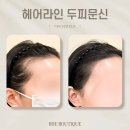 첨단라인2차 | 광주광역시 두피 문신 잘하는 곳 추천 / 망한 헤어라인 이유 / M자 이마 탈모 후기