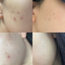 11590-나212-4 | [인천/구월] 여드름 박멸 아그네스 내돈내산 후기 포메디한의원