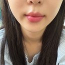 제로피부과의원 | [강남역 피부과] 얇은 입술 고민 끝! 제로피부과 입술필러 리얼 후기