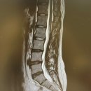 허리디스크 추간판탈출증 이행성척추 부민병원 성한유과장님 진료후기