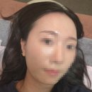 빛으로병원 | 내돈내산 이마축소 2~3개월차 후기 (병원, 부작용, 탈모, 흉터)