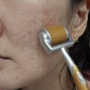 코슈마드 | 혁신개념 CE페룰릭 애씨드/ MTS 롤러 여드름 흉터 자국 홈케어 쿠팡 내돈내산 후기