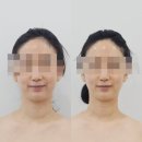 남해-209 | 대구 신부관리 물오른피부 신월성점 : 웨딩촬영 전 윤곽관리로 이중턱 박멸하고 온 후기