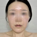 오푸스 | 오푸스레이저 &amp; 아드바티엑스 솔직후기 ! 내돈내산 피부레이저 경험담