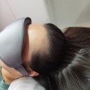 경기광주_릿따스타일] 출산 후 생긴 M자탈모 두피관리 1회차 관리 5개월 뒤