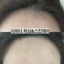 리하스킨케어 | 울산북구왁싱 리하다왁싱&amp;스킨케어에서 헤어라인 이마 왁싱 후기