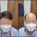 대구남자가발 새로워요