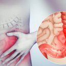 과민성 대장 증후군[irritable bowel syndrome] 이미지