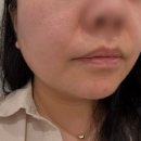 이오이오반점 | 남양주 별내피부과 피코토닝 가격 통증 솔직후기