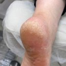 푸스케어 원주점 | 오래 서서 일하는 분들이 방문하면 좋은 푸스케어 원주점 발각질 케어 솔직 후기
