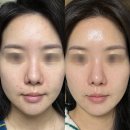 안아픈한의원 | 신사역피부과 미라젯 키닥터에게 받은 안아픈 리쥬란 효과 통증 후기