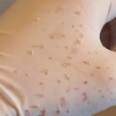 (주)헤이메디칼 | 파주피부관리 리틀헤이나에서 받은 포스트 아크네 케어 후기