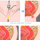 항문튀어나옴 치질만이 원인일까 이미지