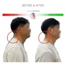 [Before &amp; After] 거북목, 버섯목 교정 / 체형교정 (울산 필라테스, 옥동 필라테스)