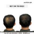제이J스칼프 | 탈모와의 전쟁: 현대인의 고민 그리고 광진구/건대 두피문신smp의 효과