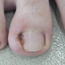 화성디에스병원 | 화성시청역 내성발톱 무좀 병원에서 통증 없이 케어 받고 왔어요