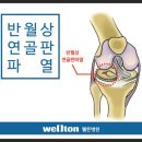 무릎연골파열, 진단과 수술이 가능한 관절내시경의 효과 이미지