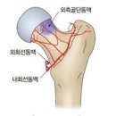 대퇴골두무혈성 괴사 그 원인은 무엇일까 이미지