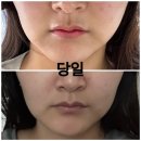 20대 후반 울쎄라400샷_메종드엠의원_바비톡이벤트_내돈내산후기