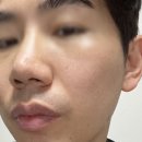 라라피부과의원 | 압구정역 피부과 리프팅 찾는다면? 올라라의원 올타이트 리프팅 찐후기(유지기간, 부작용, 효과)